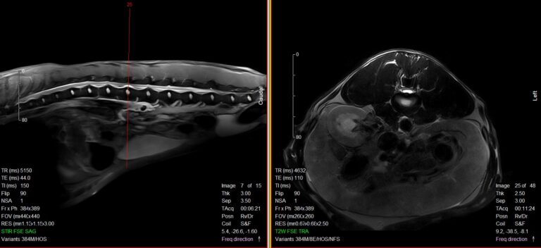 MRI image of Hero's Injury