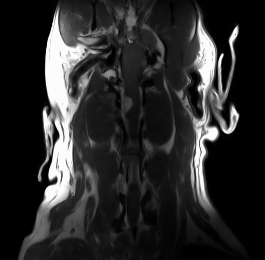 Coronal MRI View Pre-surgery