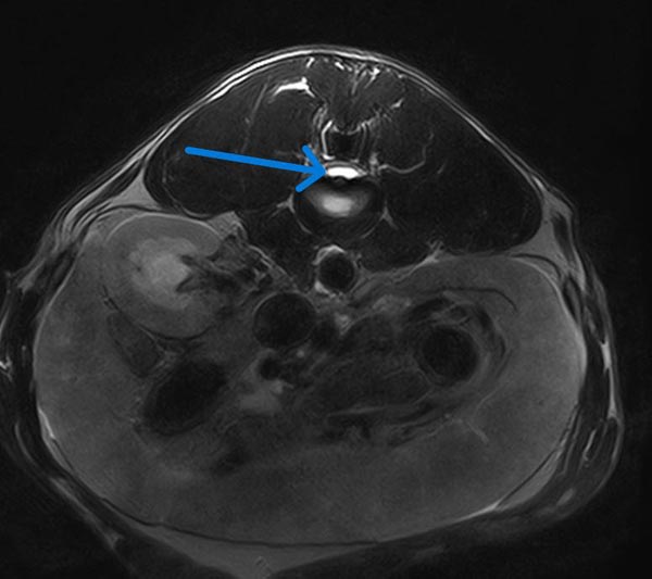 Figure 2: MRI image of a hydrated nucleus pulposus extrusion in a dog.