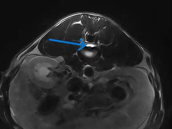 Hydrated Disc MRI Scan