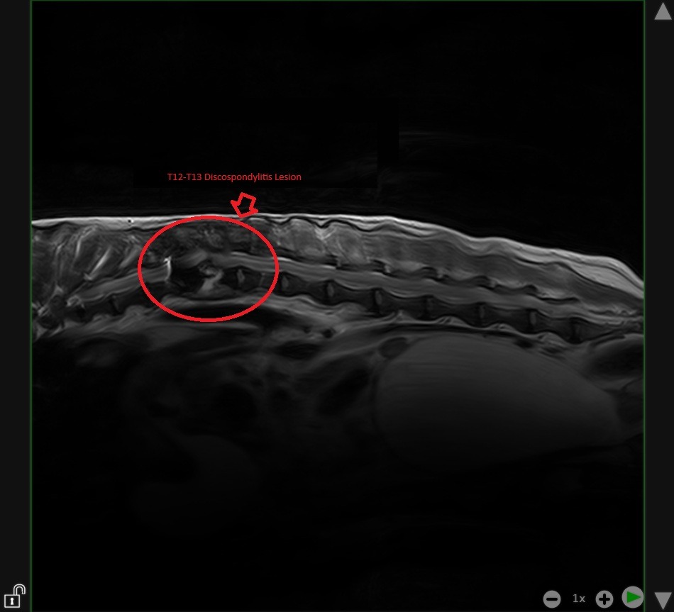 Discospondylitis Lesion